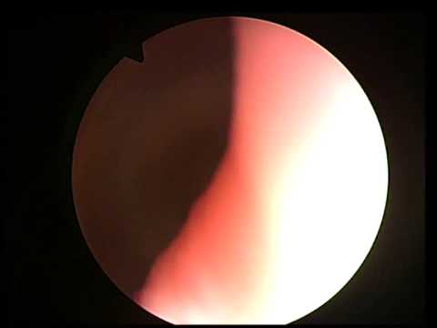 cystoscopy video