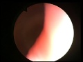 Cystoscopy & Bladder Biopsy