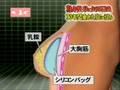 美容整形　痛みの少ない豊胸術