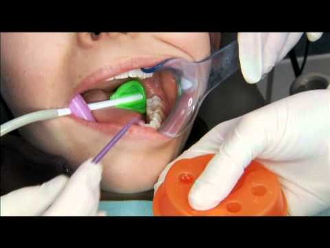Sealants See video