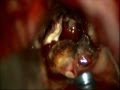 Brain aneurysm- BIG anterior communicating artery --microsurgery-dr suresh dugani/HUBLI/INDIA