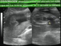 GRAVIMAGEM 869 (ULTRA-SOM 3D 4D GRAVIDEZ 27 SEMANAS)