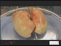 Functional Repair of Human Donor Lung by IL-10 Gene Therapy (EX VIVO Lung)