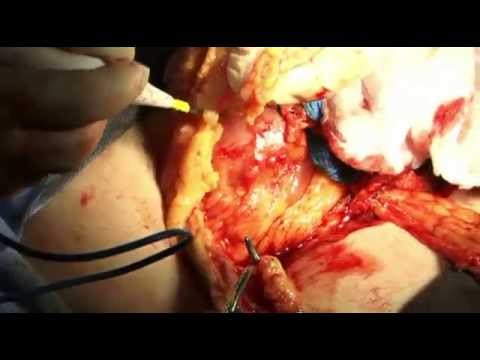 how to cure ovarian cancer