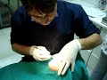 doctor javier sacando muela del juicio