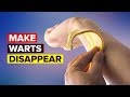 Banana Peel And Duct Tape For Warts
