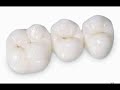 Laboratorio Dental (Estructuras en ZIRCONIO)