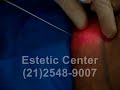 LipoLaser - Lipo laser - Gordura - Estetic Center