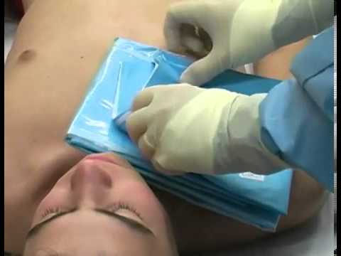 how to remove central line