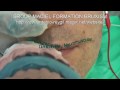 Bruxismo Tratamiento Video