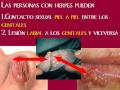 Herpes Genital Herpes Genital