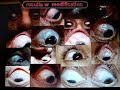 Modified Trabeculectomy with MMC in glaucoma surgery
