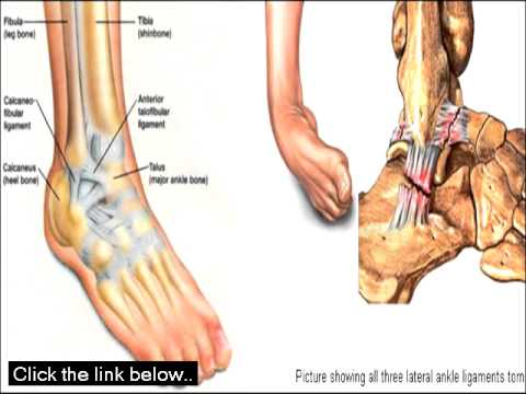 how to relieve gout pain naturally