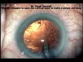 At the end of the phaco and before I remove the instrument I use the Chopper to Open the Cortical Material to have a space between the Capsule and the cortex for the J-Cannula. This makes the J-Cannula use very easy and effective.