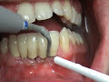 Periosoft? mini-tips, Tips PH2L & PH2R