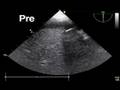 videos de TEE Hepatic vein cannulation
