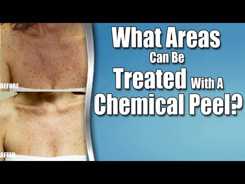 how to treat tca chemical burn