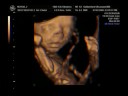 Oliver Novoa - 4D Ultrasound - Part 3