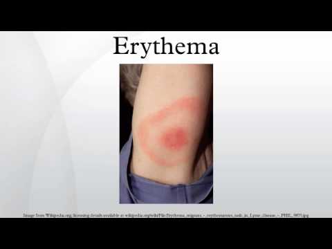 how to relieve erythema multiforme