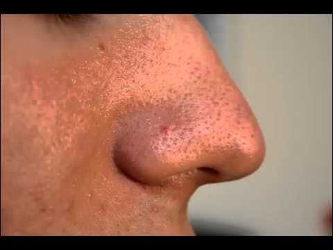how to dissolve blackheads on nose