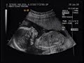Melissa Ultrasound