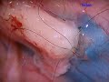 vasectomy