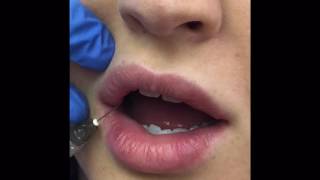 Lets Take the Fear out of Lip Injections with Juvederm!!