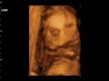 Dzaky Mom 6 Month Pregnant   4 Dimension UltraSonoGraphy 7 Ultrasonography
