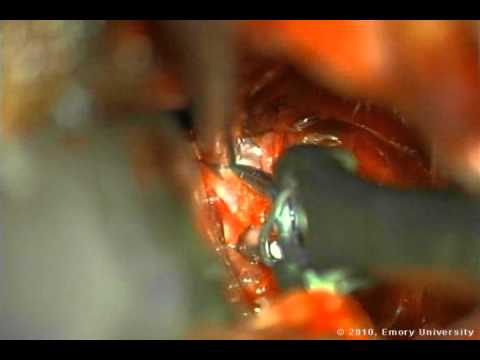Cotton-Clipping Method Of Intraoperative Aneurysm Tear Ligation - Part 1