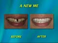 Benefits of a Full mouth Rejuvination Benefits of a Full mouth Rejuvination