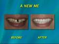 Benefits of a Full mouth Rejuvination