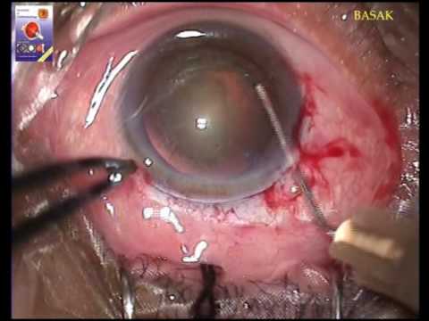 EXTRA CAPSULAR