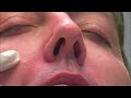 Filler Procedure-Radiant Complexions Dermatology Clinics Filler Procedure-Radiant Complexions Dermatology Clinics