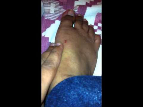 how to treat spider bites