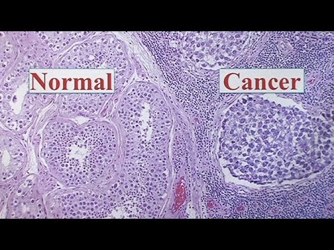 how to cure testicular cancer