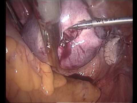 Subtotal Uterus Removal: Classic Interfascial Supracervical Hysterectomy