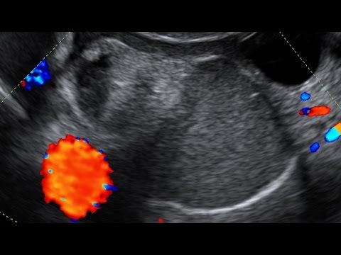 how to locate ovaries on ultrasound