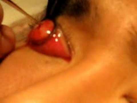 how to unclog pores on vulva