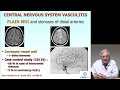 Click to View : Vascularite cérébrale/vascularite du système nerveux central 1ère partie diagnostic