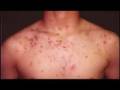 What is Acne?