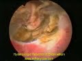 Hysteroscopic Endometrium Resection Hysteroscopic Endometrium Resection