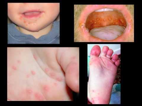 how to treat hfmd in babies