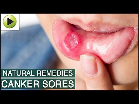 how to relieve ulcer pain in mouth