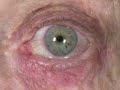 Acne Rosacea Eye Ocular