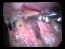 Laparoscopic Myomectomy for Recurrent Fibroids