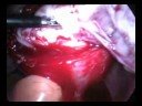 Laparoscopic Myomectomy for Recurrent Fibroids