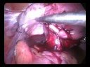 Laparoscopic Myomectomy for Recurrent Fibroids
