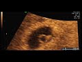 Ecografia de 6 semanas. Ecografia de 6 semanas.