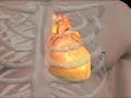Enlarged Heart Animation