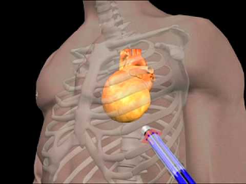 how to cure enlarged heart